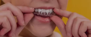 Invisalign Go – Allineatori trasparente a Torino